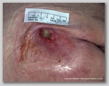 pressure ulcer