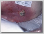 pressure ulcer
