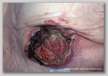 pressure ulcer
