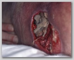 pressure ulcer