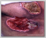 pressure ulcer