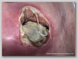 pressure ulcer
