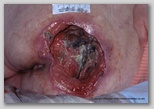pressure ulcer
