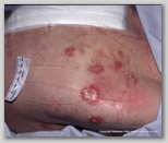 pressure ulcer