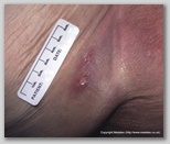 pressure ulcer