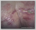 pressure ulcer