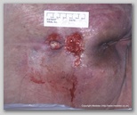 pressure ulcer