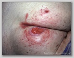 pressure ulcer