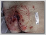 pressure ulcer