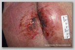 pressure ulcer