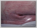 pressure ulcer