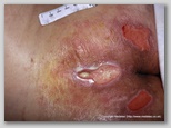 pressure ulcer