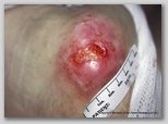 pressure ulcer