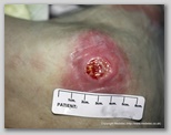 pressure ulcer