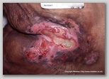 pressure ulcer