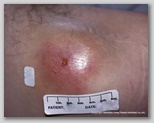 pressure ulcer