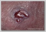 pressure ulcer
