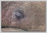 pressure ulcer