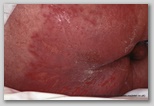 pressure ulcer