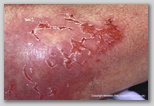 pressure ulcer