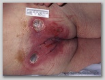 pressure ulcer