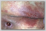 pressure ulcer