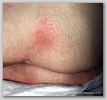pressure ulcer