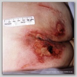 pressure ulcer