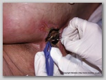 pressure ulcer