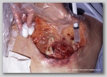 pressure ulcer