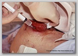 pressure ulcer