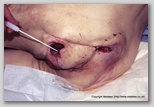 pressure ulcer