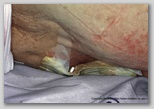 pressure ulcer