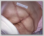 pressure ulcer