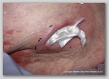 pressure ulcer
