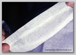 pressure ulcer
