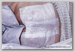pressure ulcer