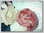 pressure ulcer