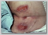 pressure ulcer