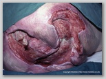pressure ulcer