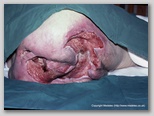 pressure ulcer
