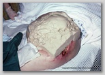 pressure ulcer