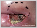 pressure ulcer