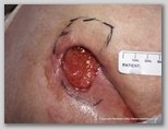 pressure ulcer