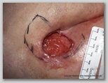pressure ulcer