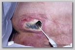 pressure ulcer