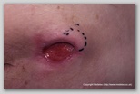pressure ulcer