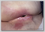 pressure ulcer