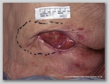 pressure ulcer