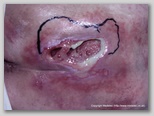 pressure ulcer
